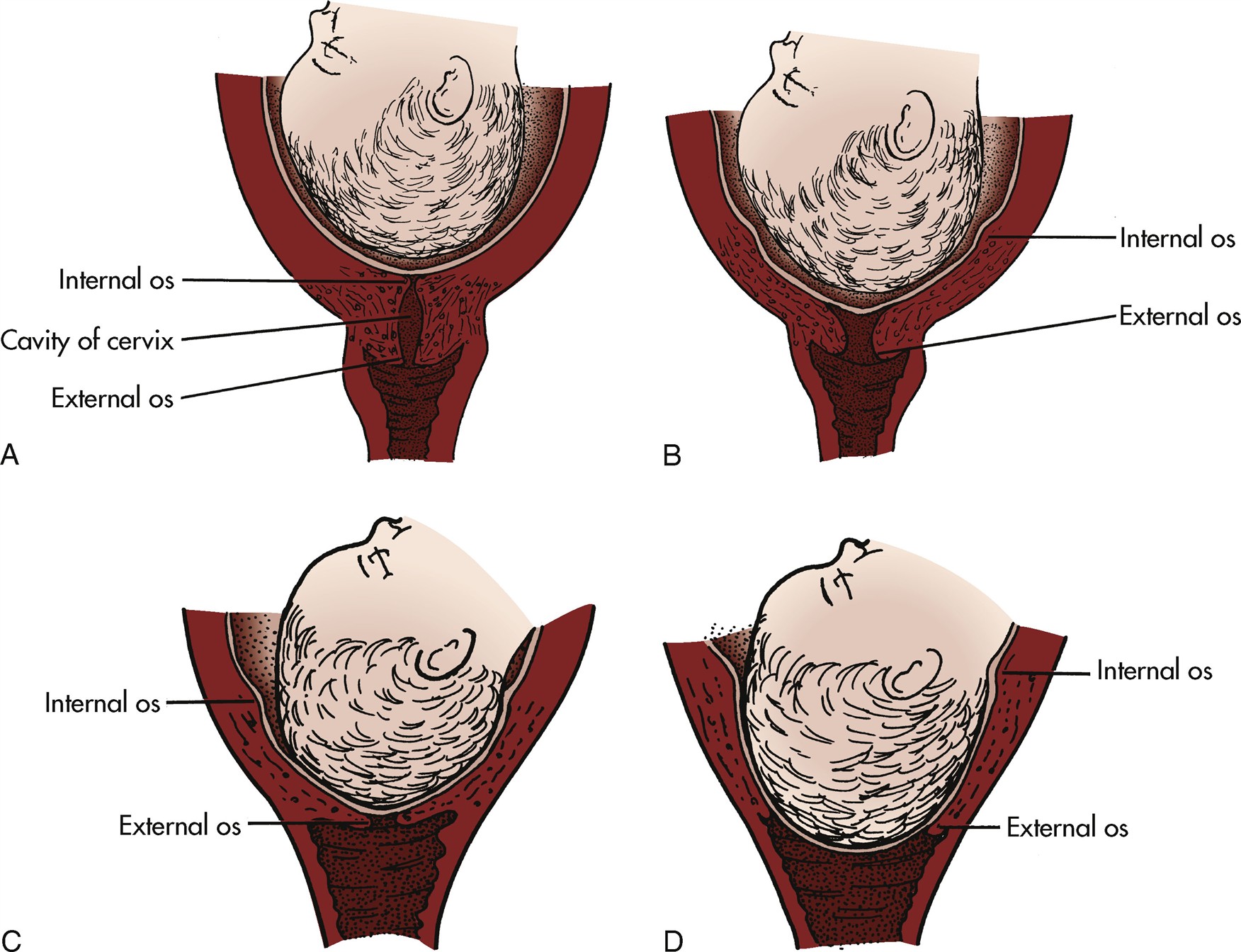 <p>Dilation</p><ul><li><p><strong>Measurement:</strong> Opening of the cervical canal measured in <strong>centimeters (0-10 cm)</strong></p></li><li><p><strong>Full dilation:</strong> Approximately 10 cm, marking the end of the first stage of labor</p></li><li><p><strong>Complete dilation:</strong> Cervix can no longer be palpated by the examiner</p></li><li><p><strong>Progress:</strong> Allows passage of the fetus through the birth canal</p></li></ul><ul><li><p>Dilation of the cervix is the enlargement or widening of the cervical opening and the cervical canal that normally occurs once labor has begun. The diameter of the cervix increases from less than 1 cm to full dilation (approximately 10 cm) to allow birth of a term fetus. When the cervix is fully dilated (and completely retracted), it can no longer be palpated by an examiner. Full cervical dilation marks the end of the first stage of labor.</p><ul><li><p>Cervical Effacement and Dilation. Note how the cervix is drawn up around presenting part (internal os). Membranes are intact, and the head is not well applied to the cervix. (A) Before labor. (B) Early effacement. (C) Complete (100%) effacement. The head is well applied to the cervix. (D) Complete (10 cm) dilation. Cranial bones overlap somewhat, and membranes are still intact.</p></li></ul></li></ul><p></p>