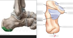 <p>Common site for bone spurs, Achilles tendon attaches</p>