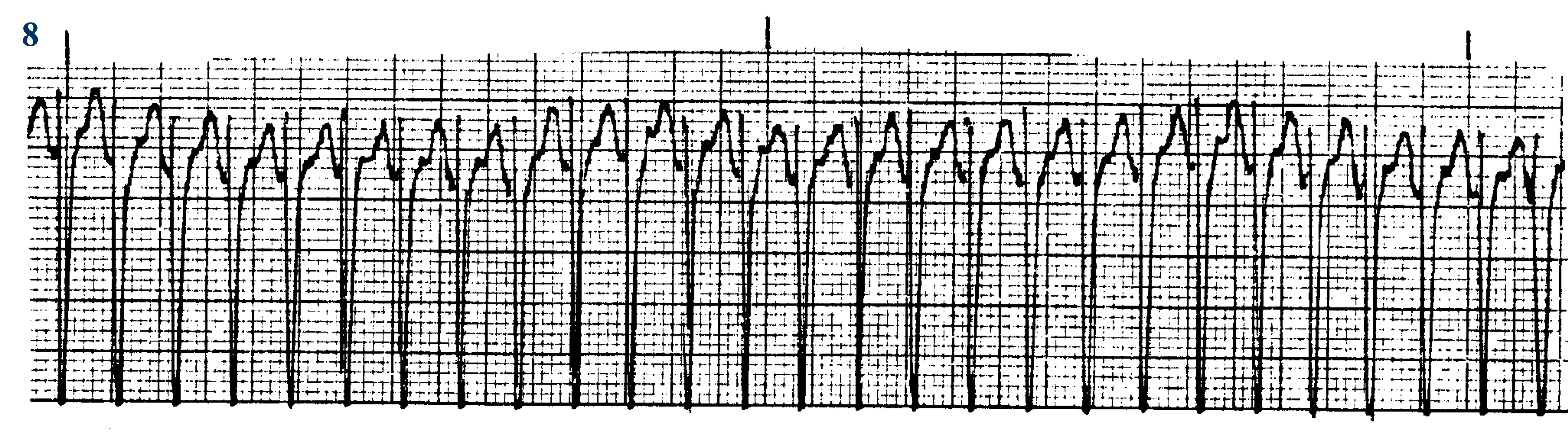 <p>What ECG is this? </p>