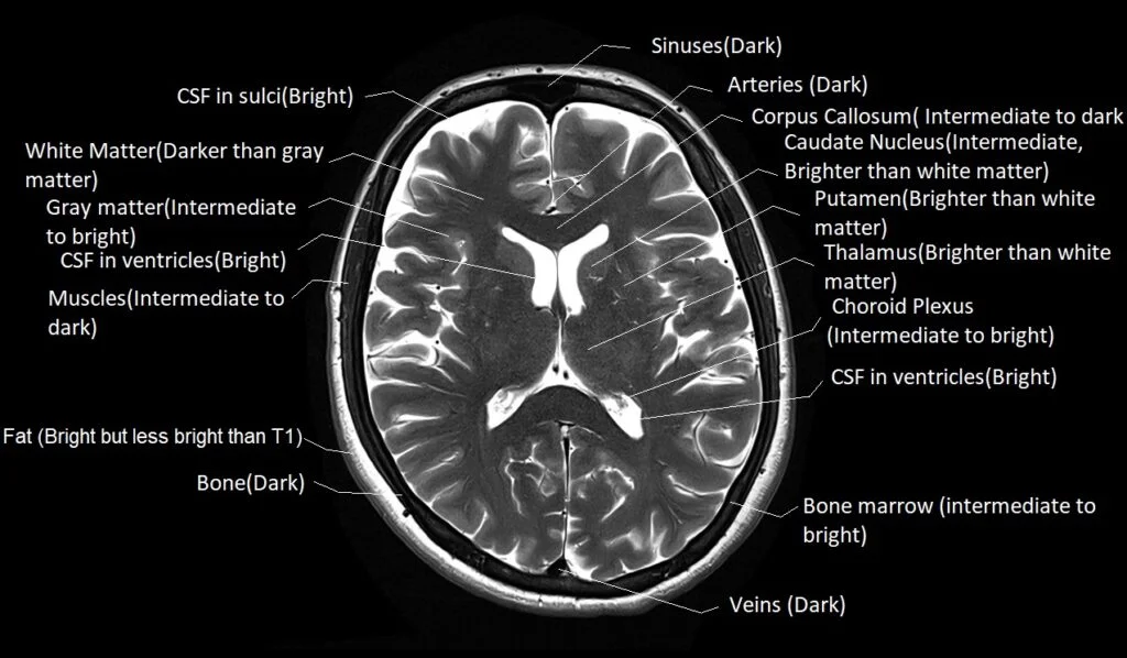 <p>grey matter, hyperintense</p>