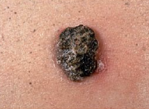 <p>nodular</p>