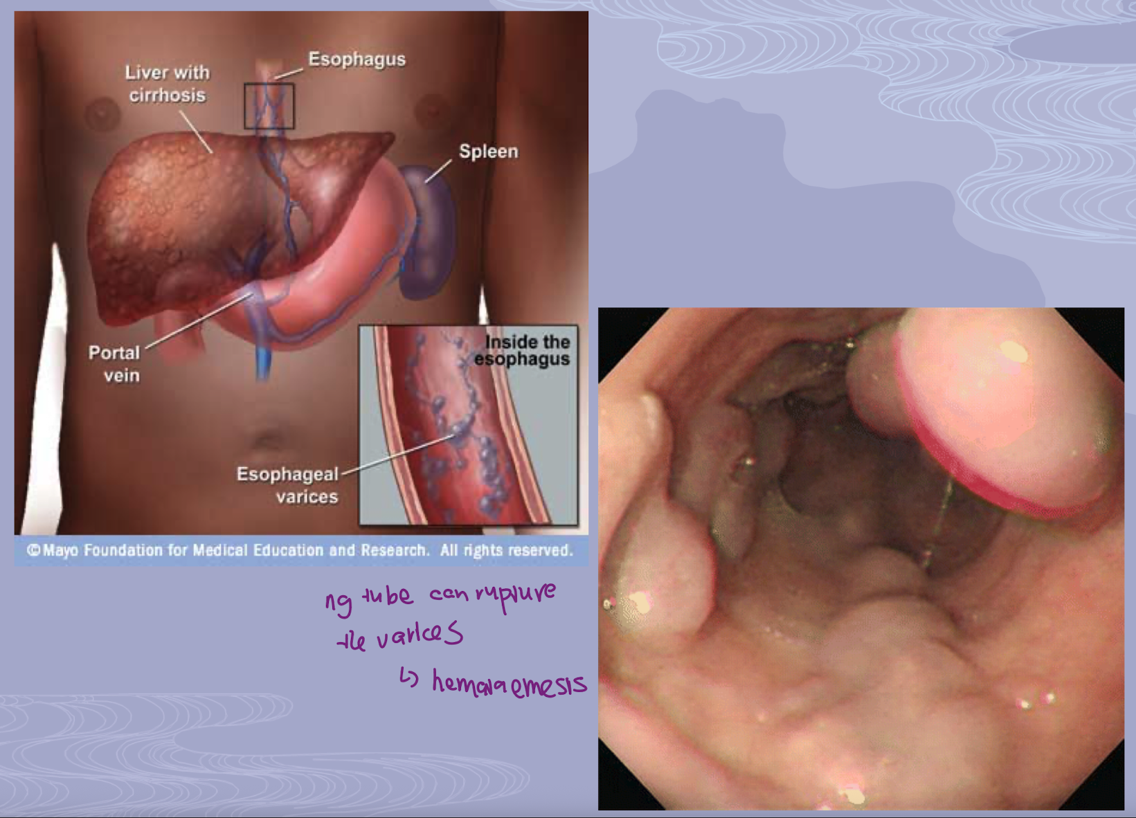 <p>when portal hypertension occurs, blood is directed into collateral veins around the esophagus of which these veins become distended, fragile, and prone to rupture → making varices a life-threatening complications of cirrhosis</p><ol><li><p>these ruptes can be cause by irritation from food or alcohol, mechanical trauma like vomiting or endoscopy, or increased esophageal pressure from coughing or straning</p></li></ol><p></p>
