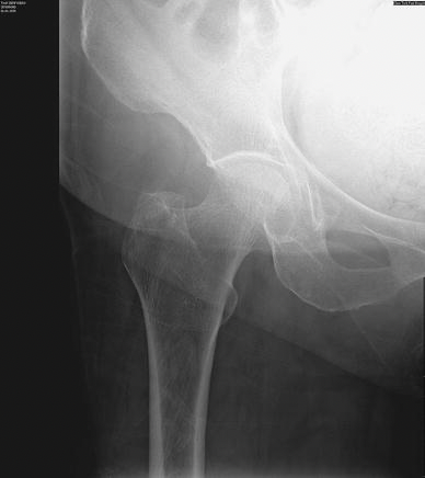 <p>A metabolic diseases which reduces <strong>bone mineral density</strong>, reducing it’s strength - mostly in older people</p><p></p><p>Radiographic appearance - The bone has a thinner cortex and larger trabecula.</p>