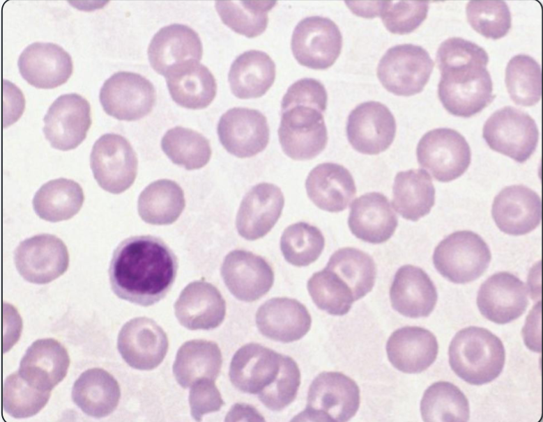 <p>What anemia does this peripheral blood smear indicate? What are the key distinguishing features?</p>