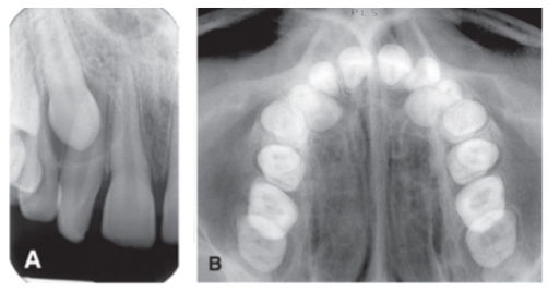 <p>Occlusal localizes in mesiodistal and buccolingual dimensions</p><p>Periapical localizes in mesiodistal and S-P dimensions</p><p>ID position of object relative to surrounding anatomic landmarks on both projections</p>