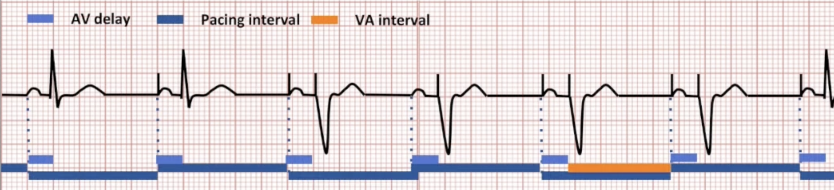 <ul><li><p>Atrial pacing driven by VA interval (AKA atrial escape interval)</p></li><li><p>VA interval = pacing interval - AV delay</p></li><li><p>Device adjusts other intervals to keep VA interval constant</p></li></ul><p></p>