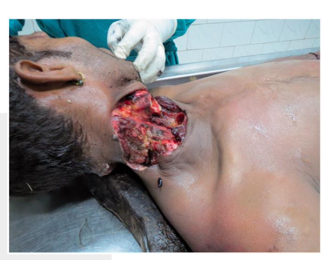 <p><strong>General features:</strong></p><ul><li><p>Usually <strong>less organised or less planned in appearance</strong></p></li></ul><p class="isSelectedEnd"><strong>Wound characteristics:</strong></p><ul><li><p>Often <strong>deep with irregular edges</strong></p></li><li><p>May <strong>sever the larynx and major blood vessels</strong></p></li></ul><p class="isSelectedEnd"><strong>Forensic indicators:</strong></p><ul><li><p><strong>Depth and direction of the wound</strong> can indicate <strong>where the offender stood</strong></p></li><li><p><strong>Additional injuries</strong> on the body (e.g., <strong>defence wounds</strong> on hands or arms)</p></li><li><p><strong>Bloodstain patterns</strong> help determine the <strong>victim’s position during the attack</strong></p></li></ul><p><strong>Significance:</strong><br>These features help differentiate <strong>homicidal injuries from suicidal cuts</strong>.</p>