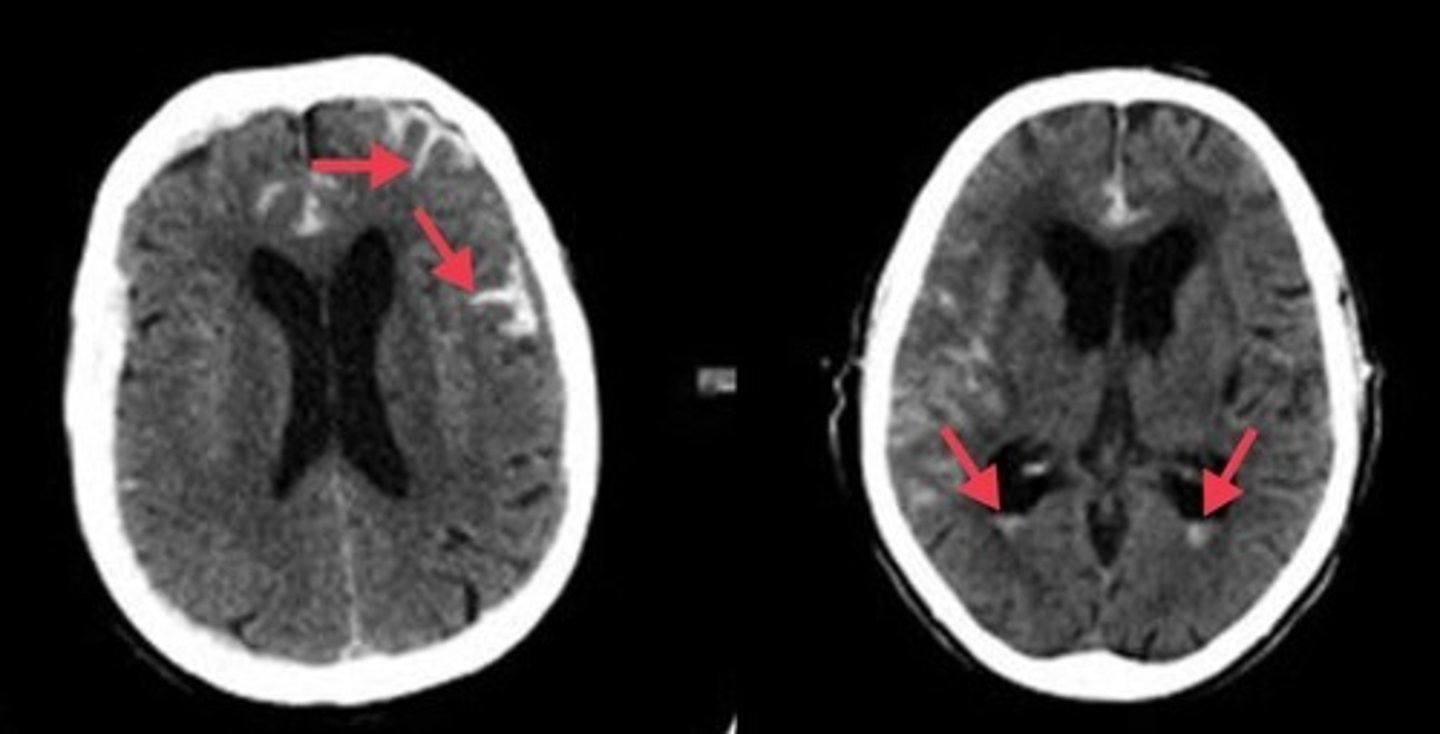 <p>where CSF is (appears bright)</p><p>conformed to CSF space surrounding brain common cause: trauma</p>