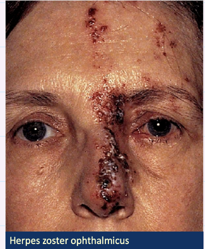 <p>Describe this image and give diagnosis?</p>