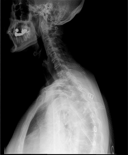 <p>Is this film of diagnostic quality (Lateral Cervical)</p>