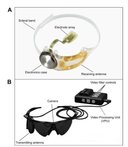 <p>• Status: Approved in Europe and received FDA approval in 2013.<br>• Components: External camera → video processing unit → transmitting antenna; internal receiving antenna + electronics case + scleral‑fixated electrode array.<br>• Clinical trial: 30 patients implanted; after 5 years, 18/30 had no device‑ or surgery‑related serious adverse events.<br>• Efficacy: Improvements were modest—patients could better locate objects (e.g., pointing to squares) and perceive direction of motion.<br>• Purpose: Provides basic visual perception for individuals with late‑stage RP.</p>