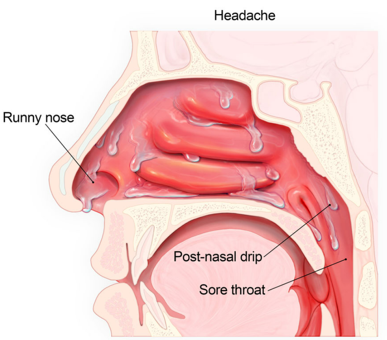 <p>Also known as <strong>rhinorrhea,</strong> it occurs as a result of</p><ul><li><p>Increased production of mucus (allergies, virus)</p></li><li><p>Increased secretions of lacrimal glands draining into the nasal cavity (crying)</p></li><li><p>Exposure to cold air (water condensation + less effective cells)</p></li></ul><p>Mucus can also travel into the pharynx</p>