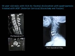 <p>approach through neck, well tolerated in most patients</p><p>- post operative dysphagia</p><p>- risk of laryngeal injury</p>