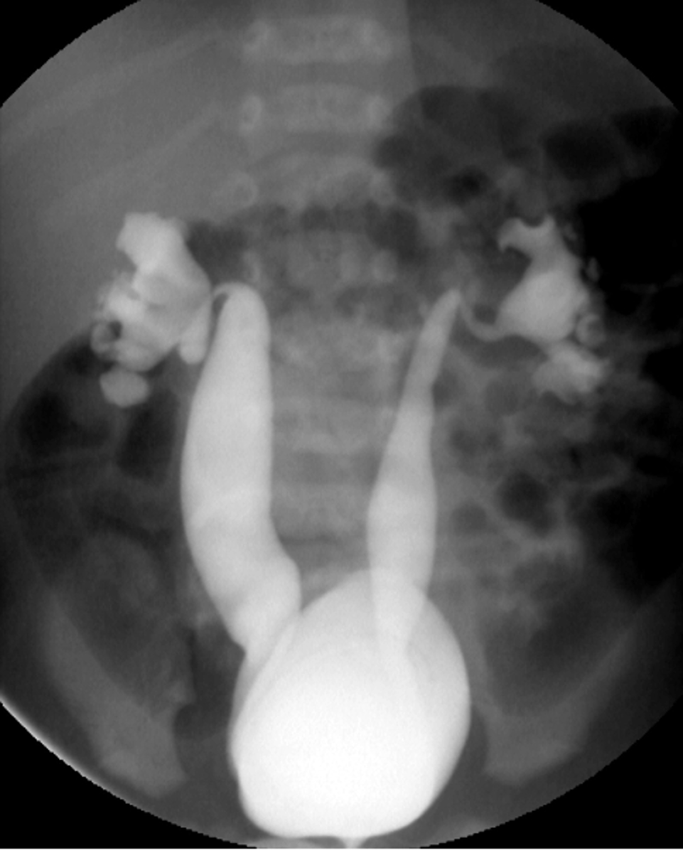 <p>BMP, UA (infection, proteinuria) +/- Voiding cystourethrogram (VCUG)</p>