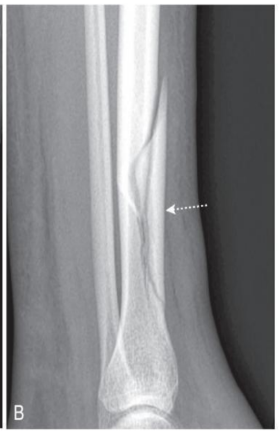 <p>type of fracture</p>