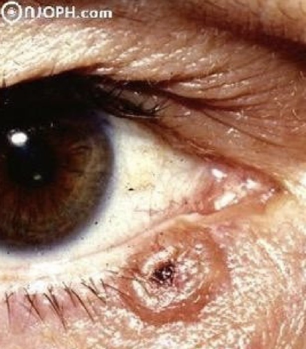 <p>Vrai ou faux ?</p><p></p><p>Cette lésion a un potentiel de métastase</p>