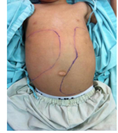 <p>Clinical Features of ALL</p>