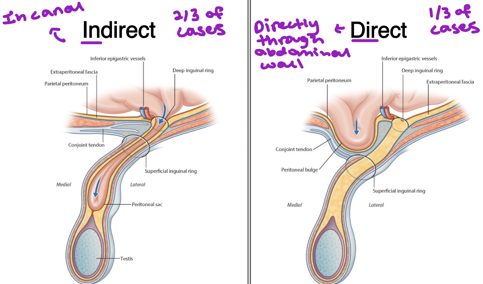 <ul><li><p>Indirect = in canal → 2/3 of cases</p></li><li><p>Direct = directly through abdominal wall → 1/3 of cases</p></li></ul><p></p>