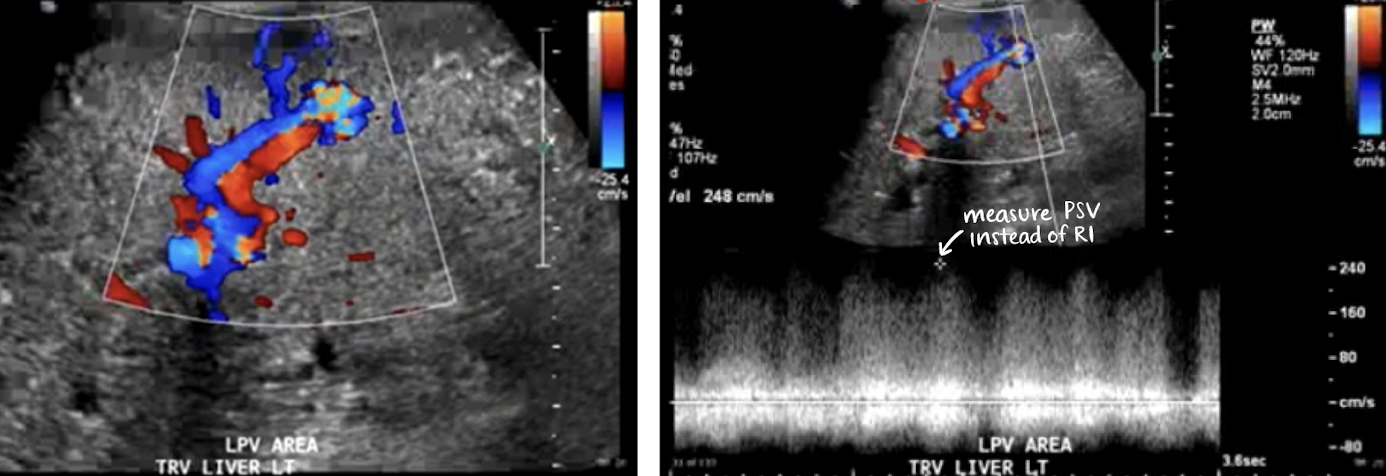 <p>AV fistula </p><ul><li><p>may be from biopsy</p></li><li><p><span style="color: red;">aliasing—arterial and venous waveform shown</span></p><ul><li><p><span style="color: red;">difficult to distinguish</span></p></li></ul></li><li><p><span style="color: red;">mosaic</span> waveform</p></li><li><p>velocity<span style="color: red;"> >200 cm/s</span></p></li></ul><p></p>