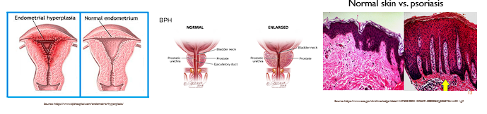 <p>Occurs due to an <span style="color: red;">abnormal stressor:</span> ( ex; excessive stimulation of hormones)</p><ul><li><p><span style="color: red;">Endometrial hyperplasia</span><span style="color: rgb(250, 249, 249);"> (increased estrogen)</span></p></li><li><p><span style="color: red;">Benign prostatic hyperplasia </span><span style="color: rgb(255, 247, 247);">(androgens)</span></p></li><li><p><span style="color: red;">Epidermal hyperplasia in psoriasis</span></p></li></ul><p></p>