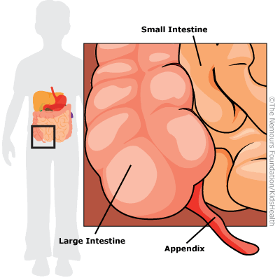 <p>acute inflammation of the appendix. occurs when it gets blocked, often by stool, and swells with bacteria</p><ul><li><p>most common cause of emergent abdominal surgery in children</p></li></ul><p></p>