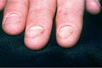 <p>Name this + its etiology</p>
