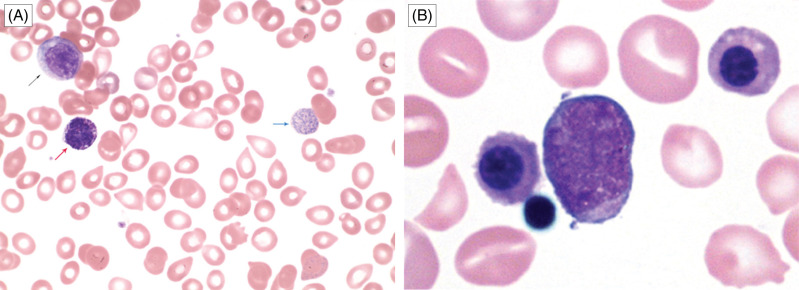 <p>MYELOPHTHISIS</p>
