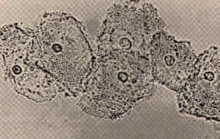 <p>⚠️76.The drug of choice for the treatment of this condition with this pathognomonic lesion is: A.Ceftriaxone B.Fluconazole C.Tetracycline D.Metronidazole</p>