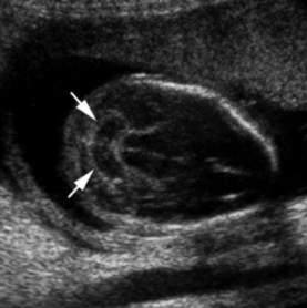 <p>If you see this when scanning the fetal head, what else will you find?</p><p>a. Holoprosencephaly</p><p>b. Choroid plexus cyst</p><p>c. Spina bifida</p><p>d. Absent corpus callosum</p>
