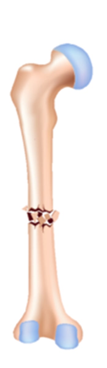 <p>bone fragments into three or more pieces</p><p>common in the elderly</p>