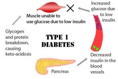 <p>insulin dependent diabetes mellitus</p>