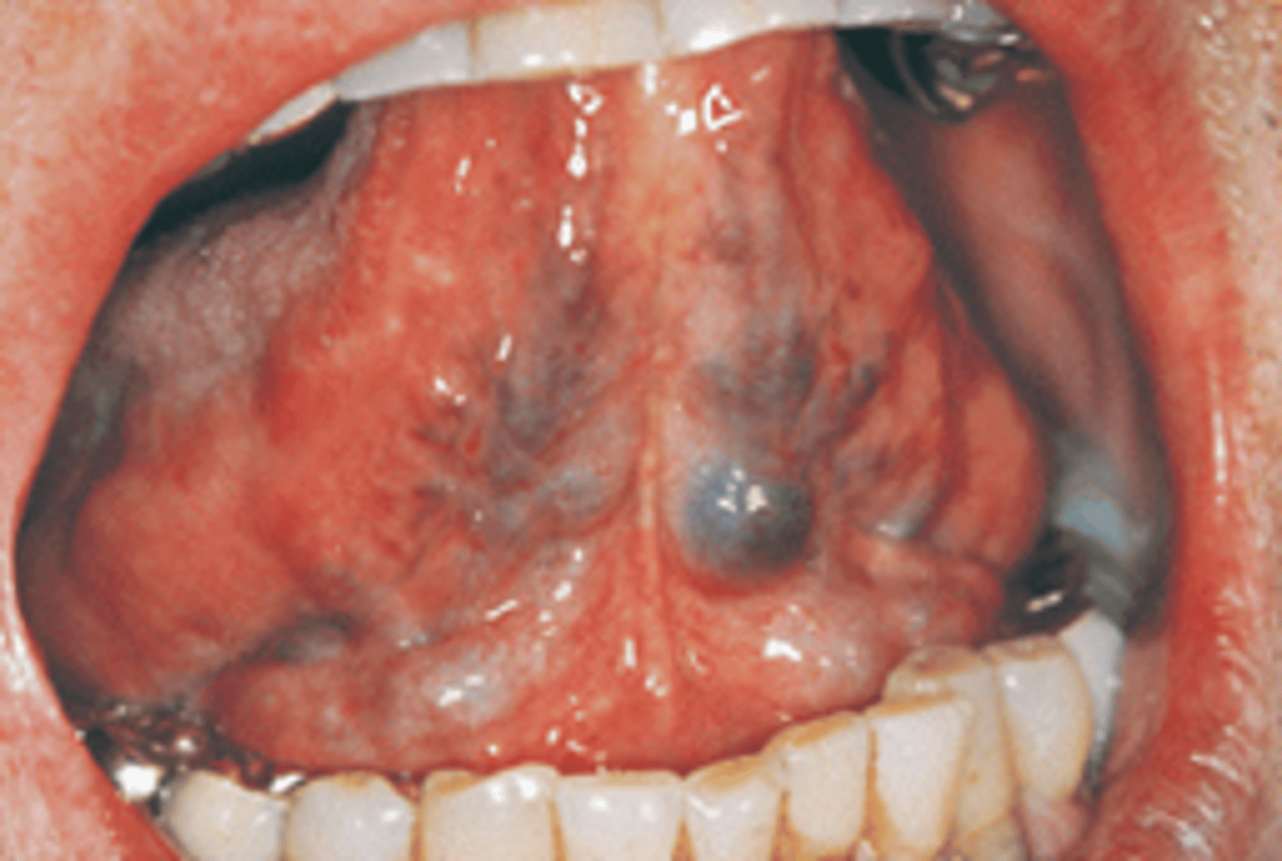 <p>- Normal</p><p>- May be very pronounced</p><p>- Protruding veins on ventral surface of the tongue</p><p><span>what are the reddish-purple clusters on the ventral surface of the tongue that are variants of normal and diagnosed via clinical exam called</span></p>