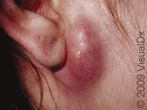<p>It may become red, swollen, tender, painful, and possibly start draining.</p>