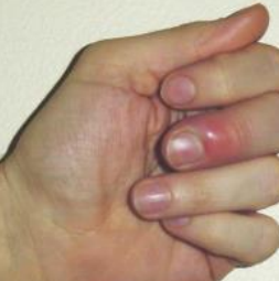 <p>Paronychia </p>