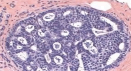 <p>What type of DCIS?</p>