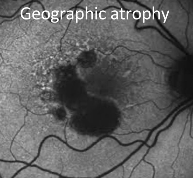 <ul><li><p>Fundus autofluorescence: using natural fluorescence of lipofuscin to check RPE/cell health</p></li><li><p>Large amts of lipofuscin indicates RPE/cell death</p></li><li><p>Might see hypoautofluorescence areas (RPE atrophy) surrounded by hyperautofluorescence (lipofuscin accumulation)</p></li></ul><p></p>