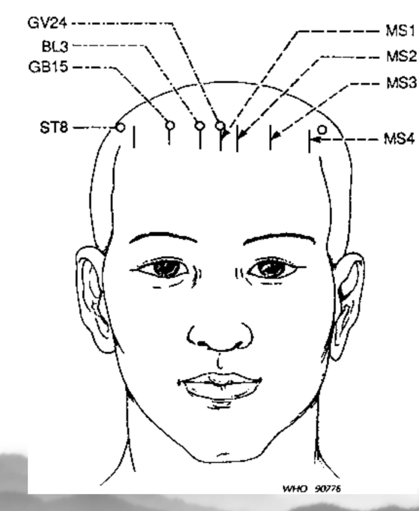 <p>1 cun long from DU 24 (in hairline right above yintang)</p><p><strong>-psychoemotional disorders</strong></p><p><strong>-nasal disorders</strong></p>