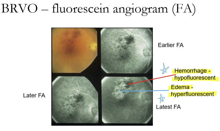 <p>Hemorrhage are hypofluorescen. Edema are hyperfluorescent. </p>