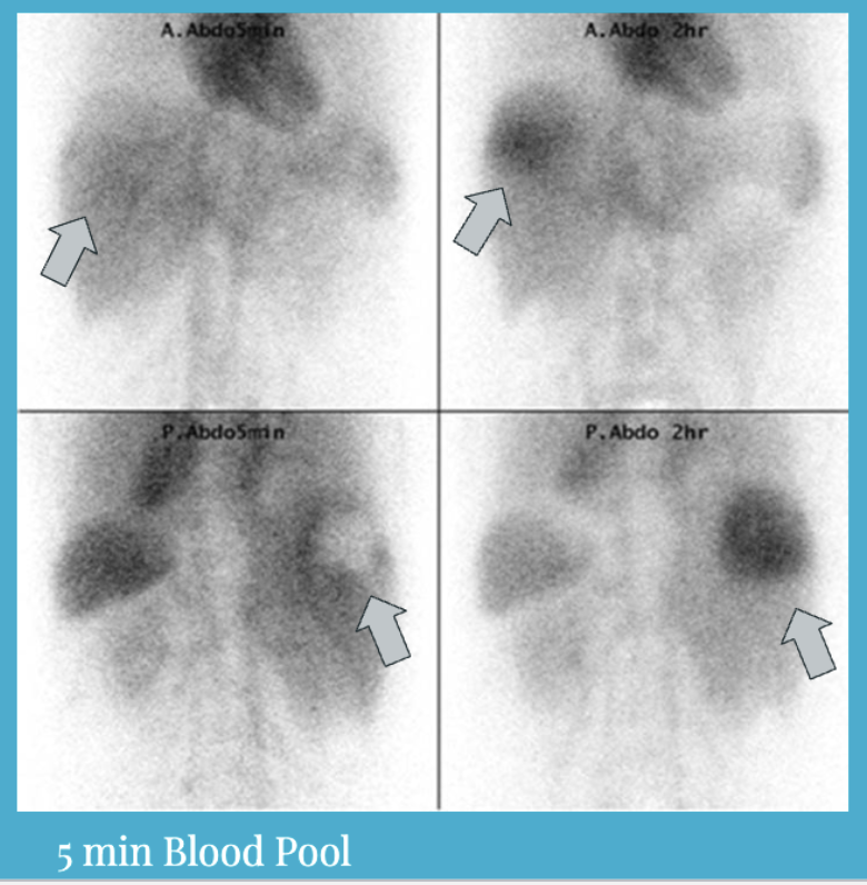 <p>is this a positive or neg liver hamangioma </p>
