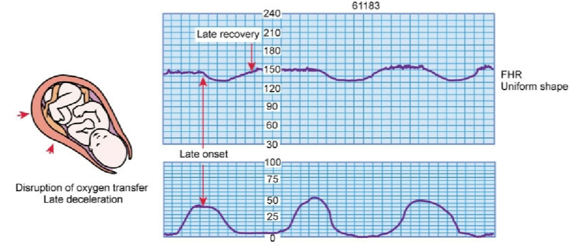 <p>slowing of the FHR that returns well after contraction has ended</p>