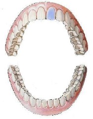<p>maxillary left central incisor</p>