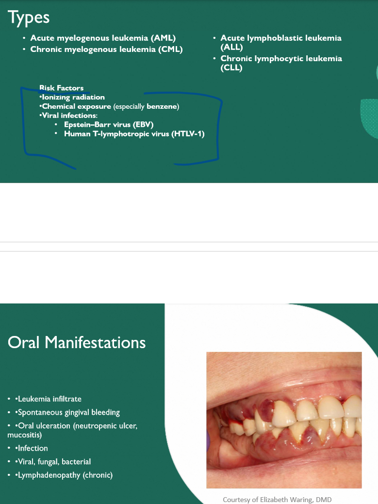 <p>Gingival enlargement (specifically with AML; secondary is spontaneous bleeding) </p>