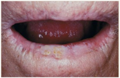 <p>~2-fold risk for lip squamous cell carcinoma (SCC)</p>