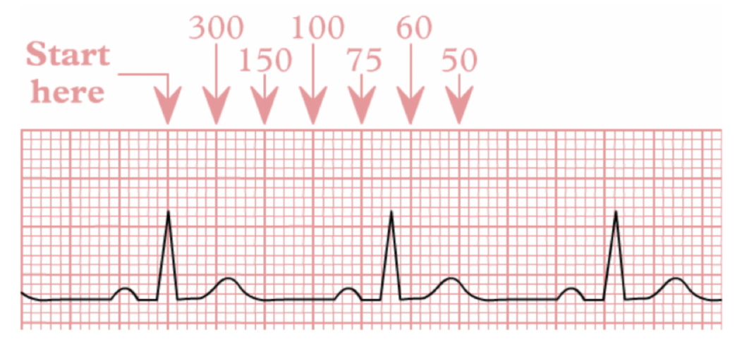 <p>3 methode om hartfrequentie te meten:</p><ul><li><p>tellen aantal QRS-complexen op 1 ECG (10-sec) *6</p></li><li><p>aftelmethode: 300 → 150 → 100 → 75 → 60 → 50 (per grote tussenruimte tussen R-toppen)</p></li><li><p>1500/ aantal kleine vakjes tussen 2 R-toppen</p></li></ul><p></p>