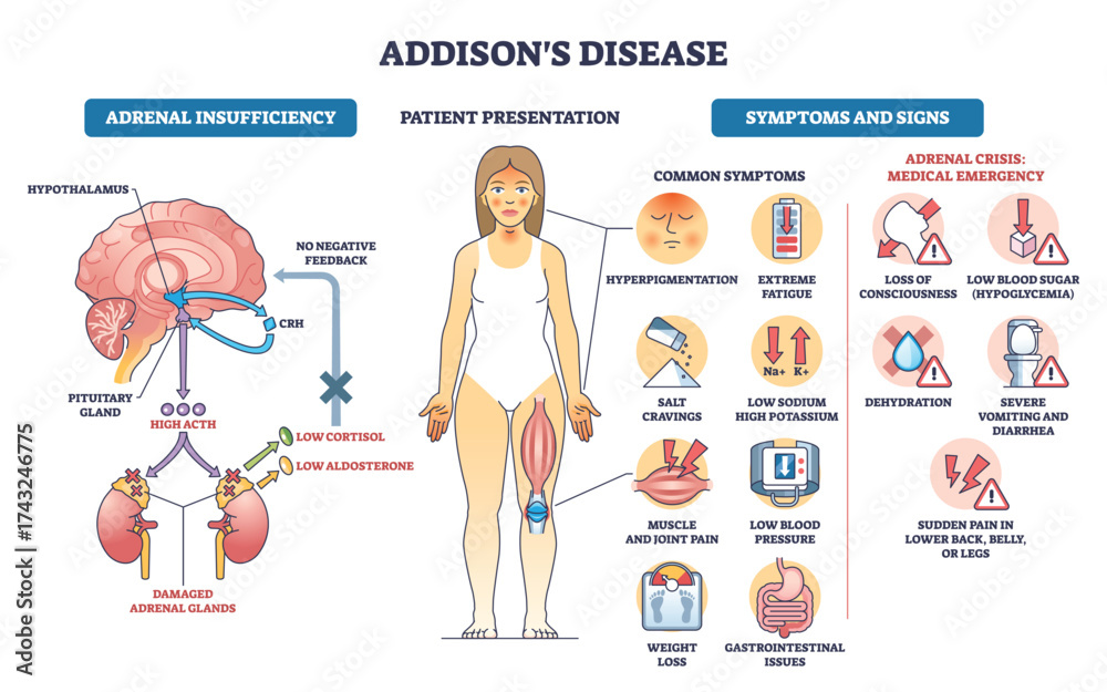 <p>primary adrenal insufficiency </p>