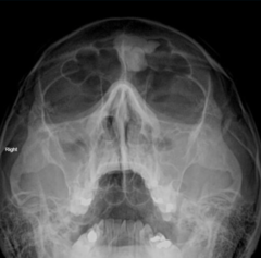 <p>What is this?</p><p>- 30-60 yo</p><p>- Pain (Chronic HA, sinusitis)</p><p>- Frontal & Ethmoid sinuses</p>