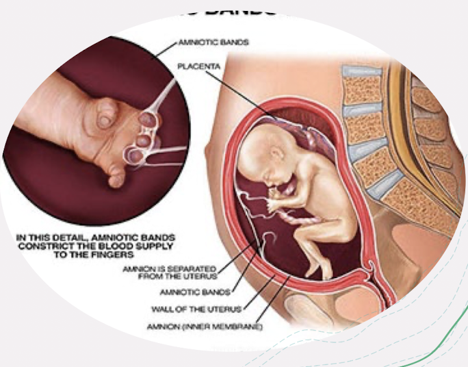 <ul><li><p>rupture of amnion → entrapment or <span style="color: red;">entanglement of fetal parts by “sticky” chorion</span></p><ul><li><p><u>early</u> entrapment → severe craniofacial defects and internal malformations</p></li><li><p><u>late</u> entrapment → amputations or limb restrictions</p></li></ul></li><li><p>increased AFP</p></li><li><p>associated abdominal wall anomalies</p><ul><li><p>gastroschisis; omphalocele </p></li></ul></li></ul><p></p>
