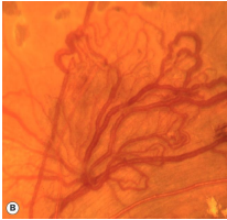 <ul><li><p>PDR → VEGF upregulation → Neovascularization</p><ul><li><p>Neovascularization of the disc (NVD)</p></li><li><p>Neovascularization elsewhere (NVE)</p></li></ul></li><li><p>Neovessles = Fragile, leaky</p><ul><li><p>Increased risk of DME</p></li></ul></li></ul><p></p>