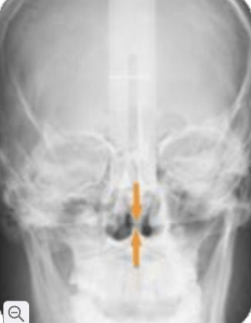 <p>nasal septum</p>