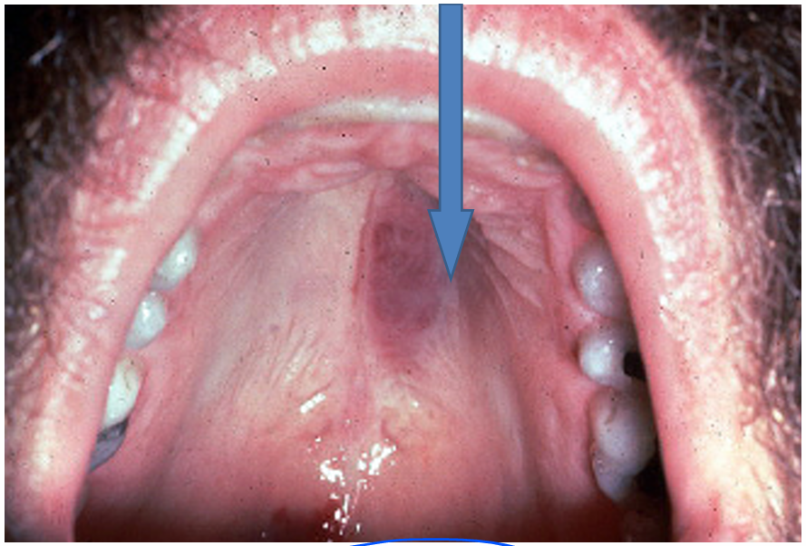 <p>1.what is this lesion?</p><p>2. how to treat/ manage it?</p><p>3. classification of oral lesion in HIV?</p>